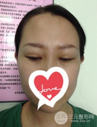 双眼皮修复术价钱和案例图