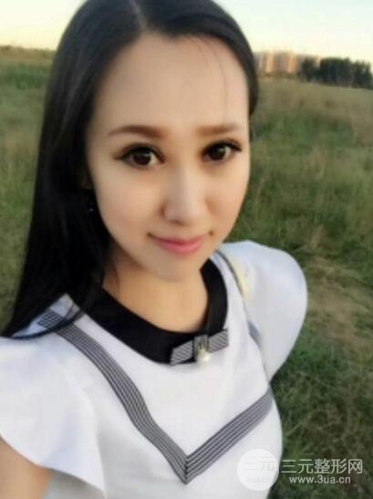 双眼皮修复术价钱和案例图