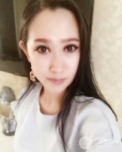 双眼皮修复术价钱和案例图