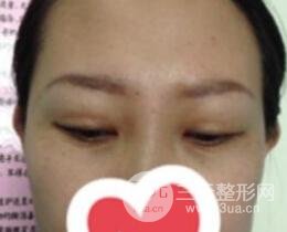 双眼皮修复术价钱和案例图