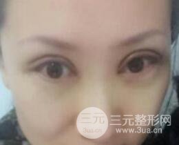 双眼皮修复术价钱和案例图