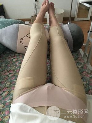 珠海莱茵门诊部卢刚给我做的大腿抽脂手术，前后对比图分享