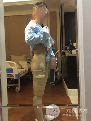 珠海莱茵门诊部卢刚给我做的大腿抽脂手术，前后对比图分享