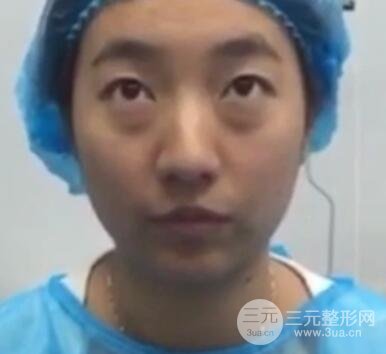 微创内切去眼袋手术价格和恢复过程图案例