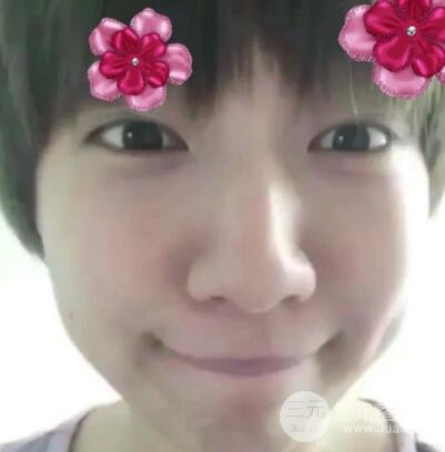 微创内切去眼袋手术价格和恢复过程图案例