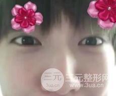 微创内切去眼袋手术价格和恢复过程图案例