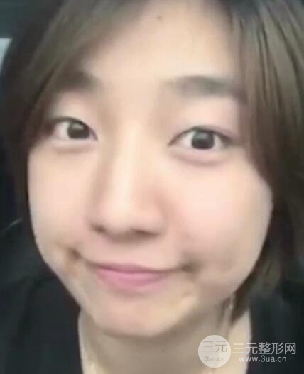 微创内切去眼袋手术价格和恢复过程图案例