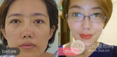 超声法去眼袋价格和前后图片案例