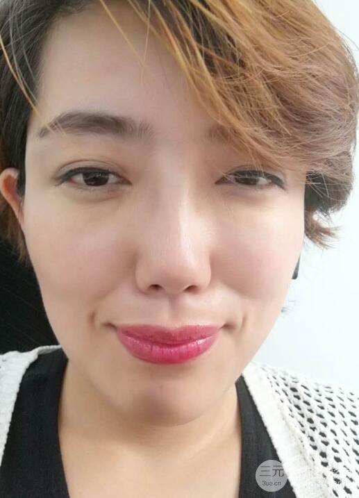 超声法去眼袋价格和前后图片案例