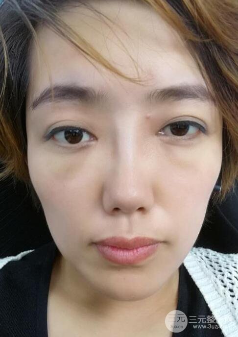 超声法去眼袋价格和前后图片案例