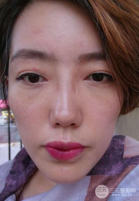 超声法去眼袋价格和前后图片案例