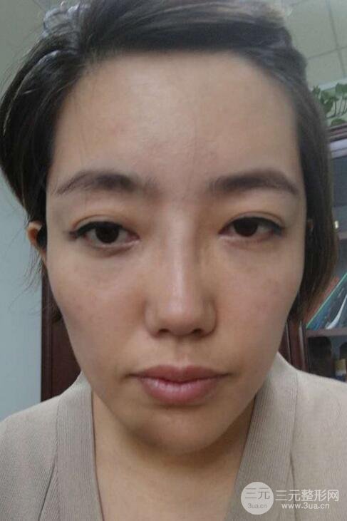 超声法去眼袋价格和前后图片案例