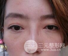 超声法去眼袋价格和前后图片案例