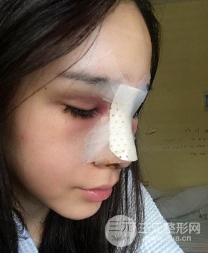 武汉美都张召医生给我做的隆鼻整形手术，给大家分享一下前后照片