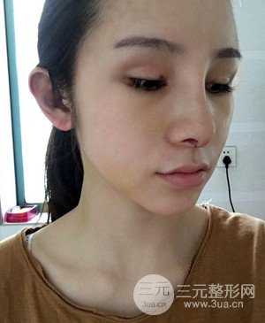 武汉美都张召医生给我做的隆鼻整形手术，给大家分享一下前后照片