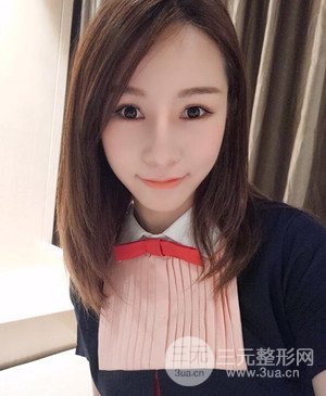 武汉美都张召医生给我做的隆鼻整形手术，给大家分享一下前后照片