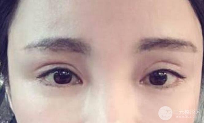 割双眼皮失败修复成功价格和案例图片