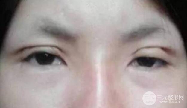割双眼皮失败修复成功价格和案例图片