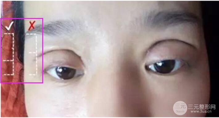 割双眼皮失败修复成功价格和案例图片