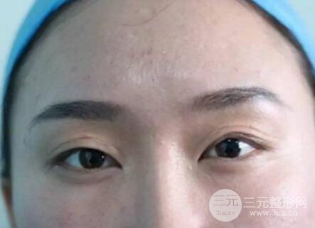 割双眼皮失败修复成功价格和案例图片
