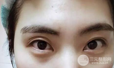 割双眼皮失败修复成功价格和案例图片