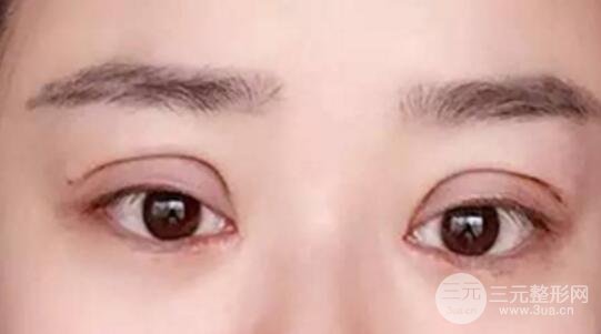 割双眼皮失败修复成功价格和案例图片