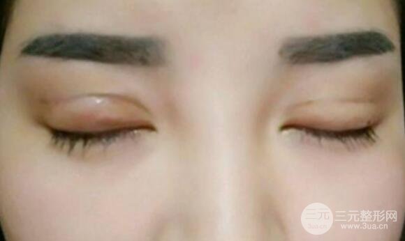 割双眼皮失败修复成功价格和案例图片