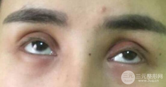 割双眼皮失败修复成功价格和案例图片
