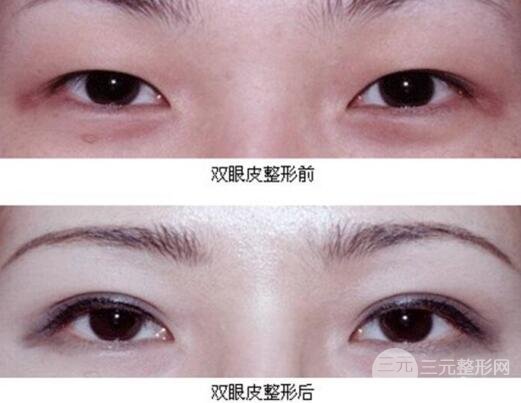 割双眼皮失败修复成功价格和案例图片