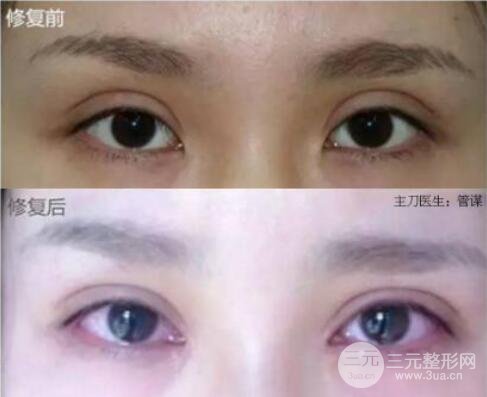割双眼皮失败修复成功价格和案例图片