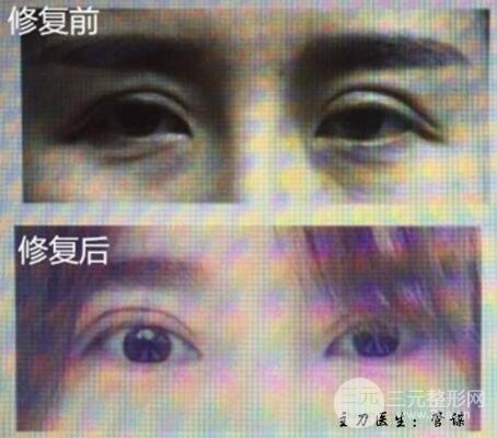 割双眼皮失败修复成功价格和案例图片