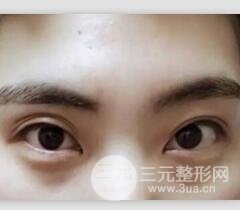 割双眼皮失败修复成功价格和案例图片