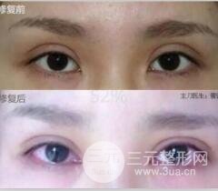 割双眼皮失败修复成功价格和案例图片