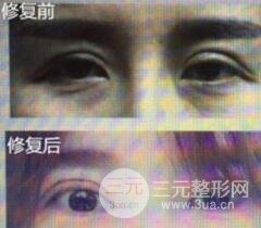 割双眼皮失败修复成功价格和案例图片