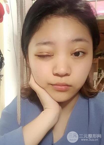 切开双眼皮手术恢复过程图案例