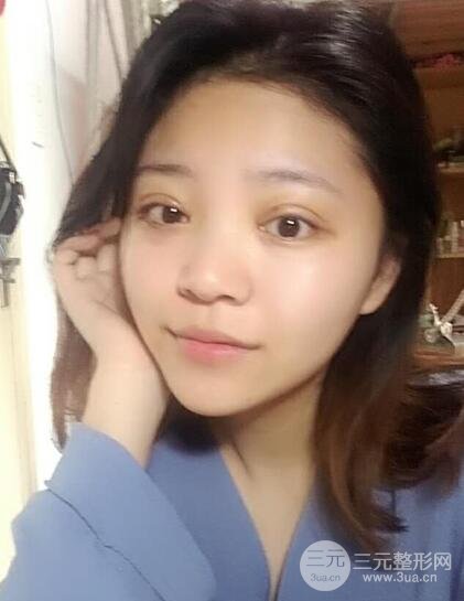 切开双眼皮手术恢复过程图案例