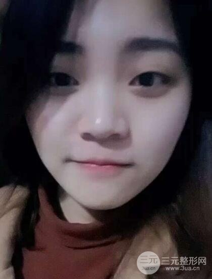 切开双眼皮手术恢复过程图案例