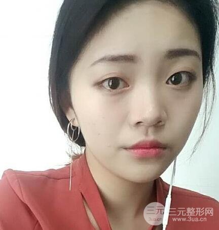 切开双眼皮手术恢复过程图案例