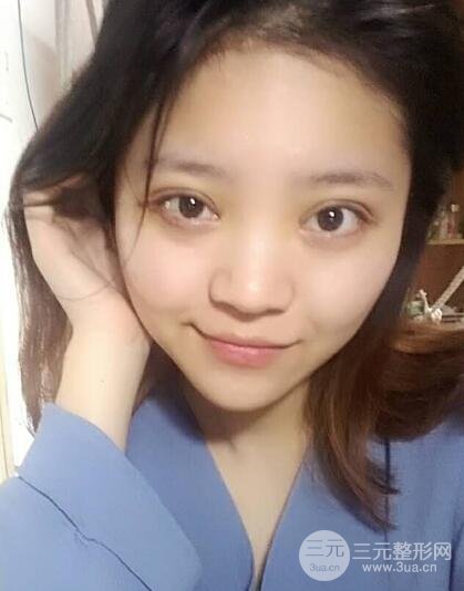 切开双眼皮手术恢复过程图案例