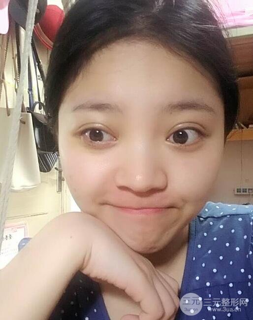 切开双眼皮手术恢复过程图案例