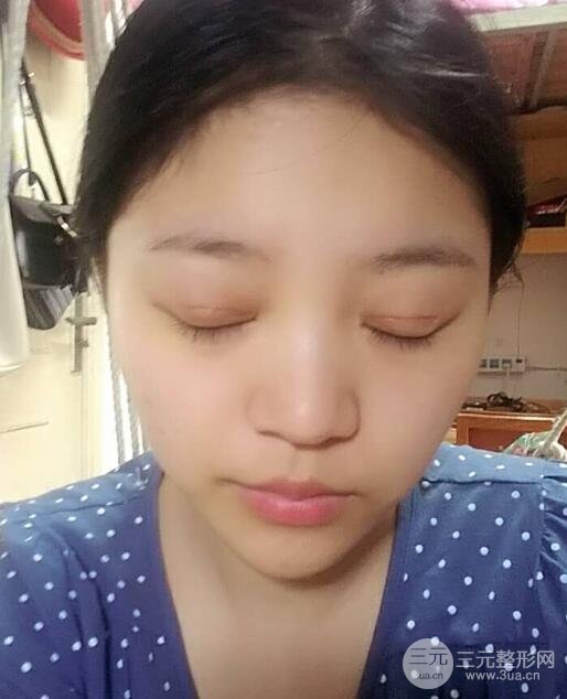 切开双眼皮手术恢复过程图案例