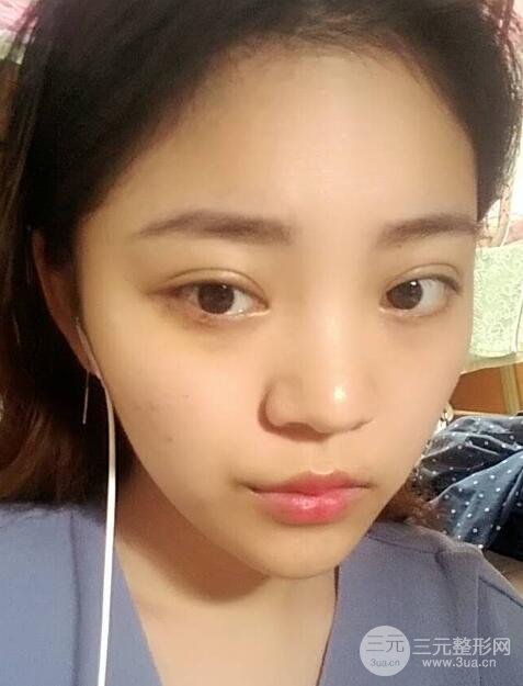 切开双眼皮手术恢复过程图案例