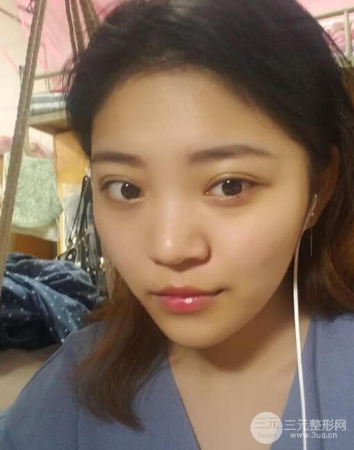 切开双眼皮手术恢复过程图案例