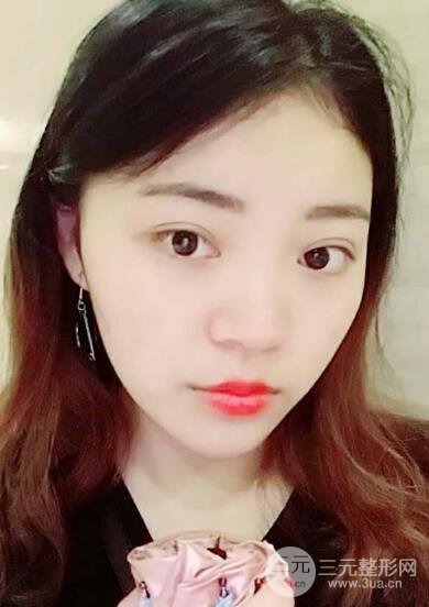 切开双眼皮手术恢复过程图案例