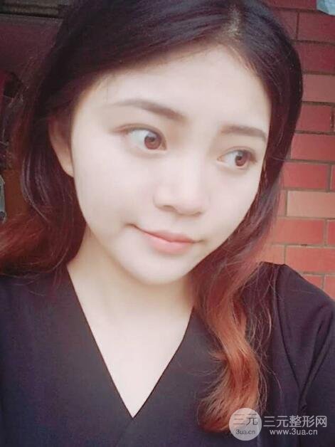 切开双眼皮手术恢复过程图案例