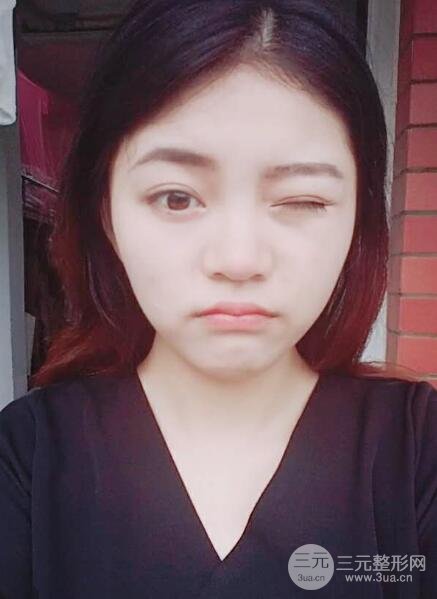 切开双眼皮手术恢复过程图案例