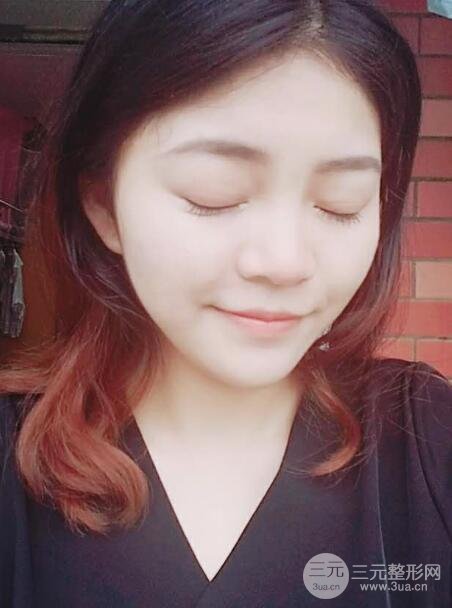 切开双眼皮手术恢复过程图案例