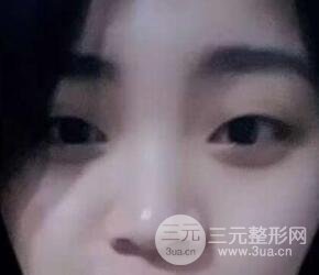 切开双眼皮手术恢复过程图案例