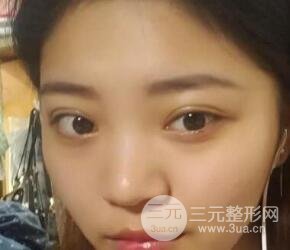 切开双眼皮手术恢复过程图案例