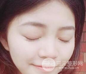 切开双眼皮手术恢复过程图案例